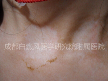 2年白癜风久治不愈1.jpg