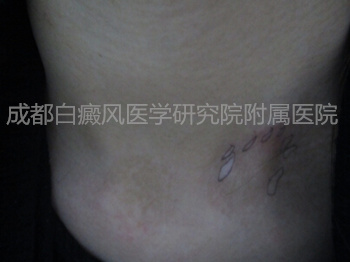 2年白癜风久治不愈2.jpg