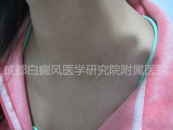 2年白癜风久治不愈3.jpg